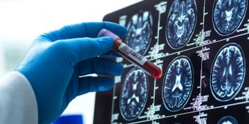 Blood Tests for Alzheimer’s Are Here
